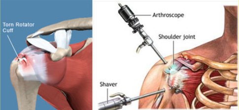 Rotator Cuff FAQ  Shoulder Surgery - G2 Orthopedics